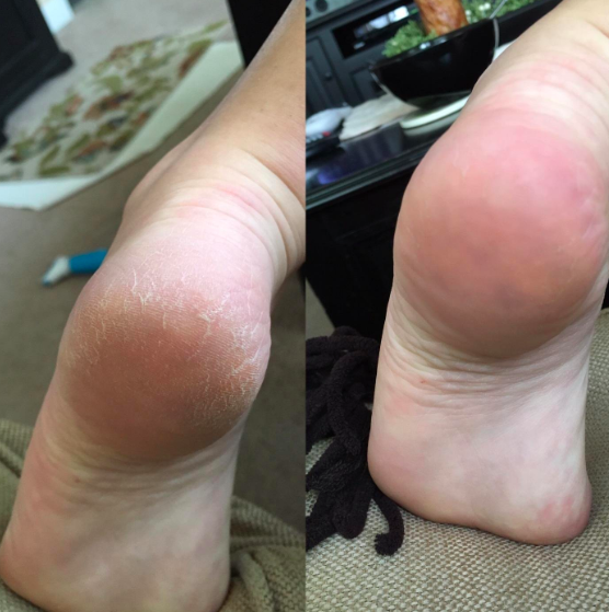Miravé Electric Foot Callus Remover