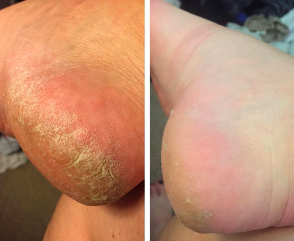 Miravé Electric Foot Callus Remover